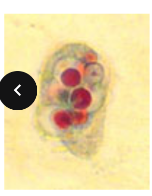 <p>Infective site - mouth (thrives in diseased gums) - destroyed in stomach when swallowed</p><p>Transmission - contact with fomites (drinking glasses, utensils, kissing)</p><p>Morphology - resembles E. histolytica (but has no cyst stage) ingests leucocytes (blood cell)</p><p></p>