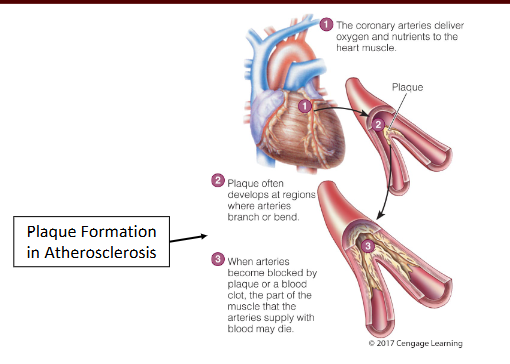 <p>the subtle damage initiates an inflammatory response that is going to attack immune cells and increase the permeability of the vessel wall</p><p>then LDLs will slip under the endothelial cells of the artery and become oxidized by local enzymes are start to accumulate</p><p>eventually the plaque will thicken and harden </p>