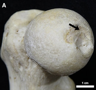<p>hole on the head of the femur — attachment point for the ligament of the head of head of the femur or the ligamentun teres</p>