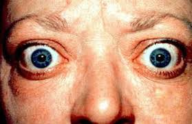 <p>PP: autoreactive T lymphocytes→protrusion of eyeball</p><p>E: thyroid eye dx (especially if unilateral protrusion)<br>trauma<br>orbital tumor<br>granulomatous dxs</p><p>CM: protruded eyeball<br>lid retraction<br>extraocular muscle dysfunction<br>dry eyes<br>ocular pain<br>lacrimation</p>