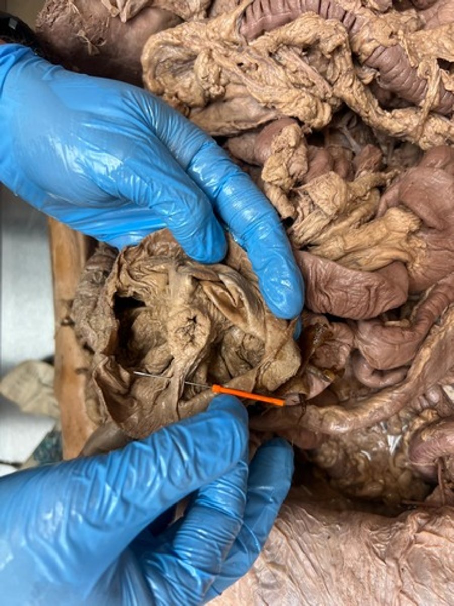 <p>anterior frenulum of ileal orifice</p>