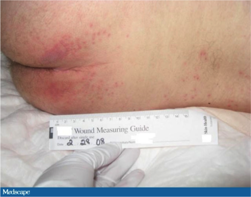 Intact skin with a non-blanchable redness of a localized reddened area