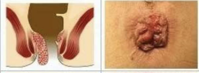 <p>Which grade of internal hemorrhoids has painless bleeding, perianal itching, swelling, and staining/soilage with mucous or feces and on exam you find that the hemorrhoid prolapses beyond the dentate line and is only <strong>reducible with manual pressure</strong>?</p>