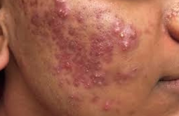 <ul><li><p><strong>Mild:</strong></p><ul><li><p>Primarily non-inflammatory lesions (comedones).</p></li></ul></li><li><p><strong>Moderate:</strong></p><ul><li><p>Comedones plus inflammatory lesions such as papules or pustules (localized to face or back).</p></li></ul></li><li><p><strong>Severe:</strong></p><ul><li><p>Lesions, similar to moderate acne, but more widespread, and/or presence of cysts.</p></li><li><p>Associated more frequently with scarring.</p></li></ul></li></ul><p></p>