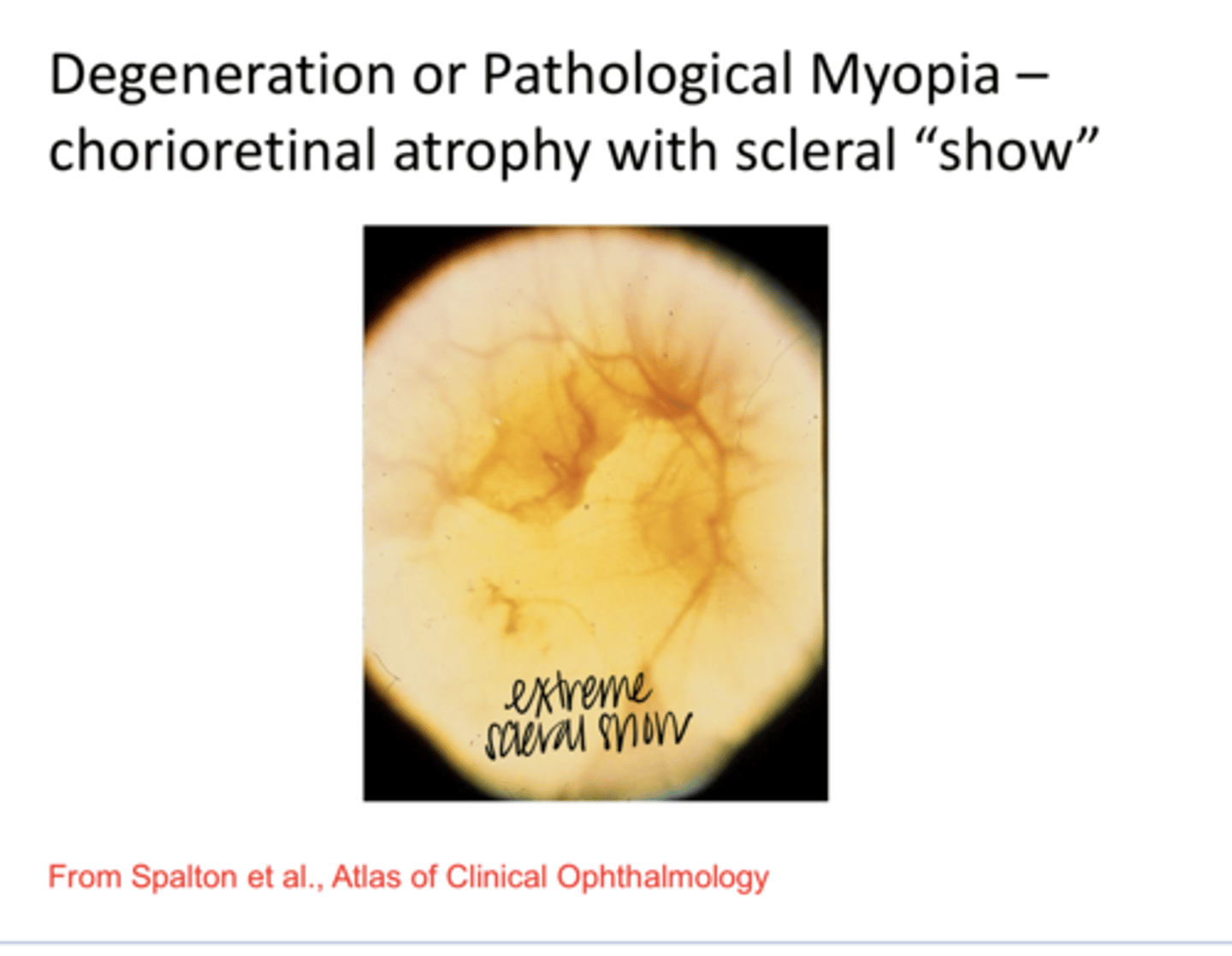 <p>Degeneration or Pathological Myopia -- Chorioretinal Atrophy with Scleral Show (Pic)</p>