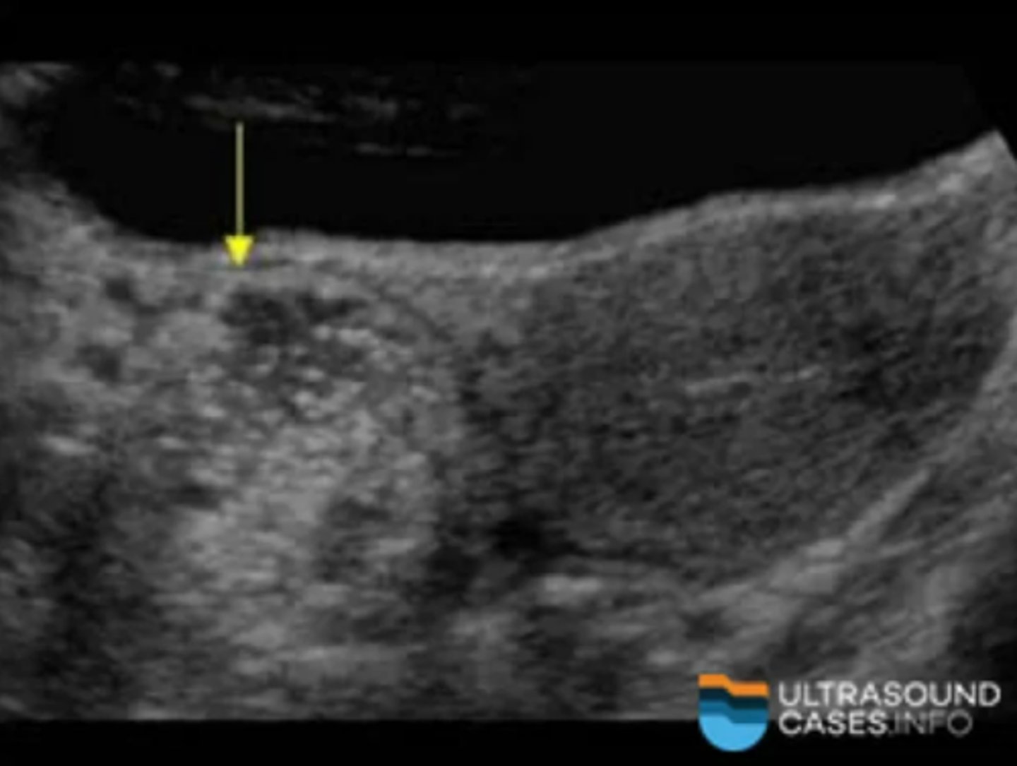 <p>Cystic teratoma</p><p>-The appearance is consistent with a dermoid or cystic teratoma</p>
