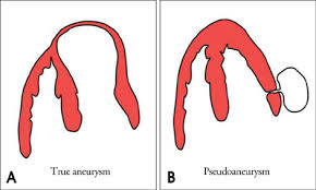 <p>A saccular outpouching with a narrow neck originating from a discontinuity in the heart wall.</p><p>Narrow neck and lack myocardial or endocardial tissue.</p>