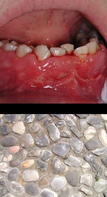 <p><span style="color: blue;"><strong><em><u>GRANULOMATOUS (but technically also autoimmune)</u></em></strong></span></p><p>Crohn’s Disease</p><ul><li><p>Clinical Signs</p></li><li><p>Etiology</p></li><li><p>Treatment</p></li></ul><p></p>