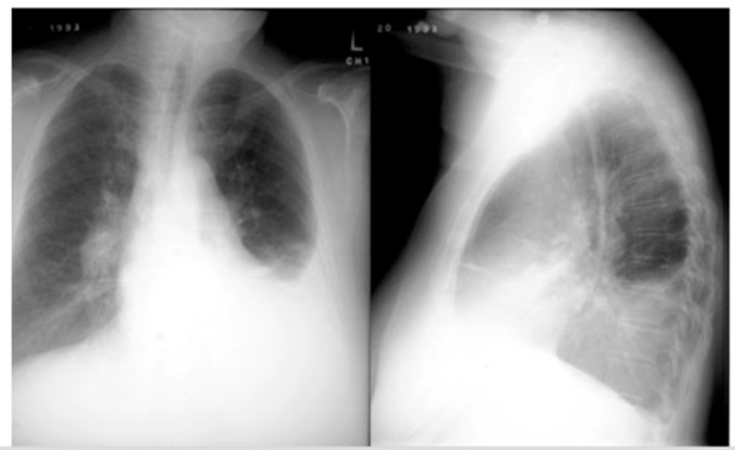 <p>What are findings that indicate pleural effusion?</p>