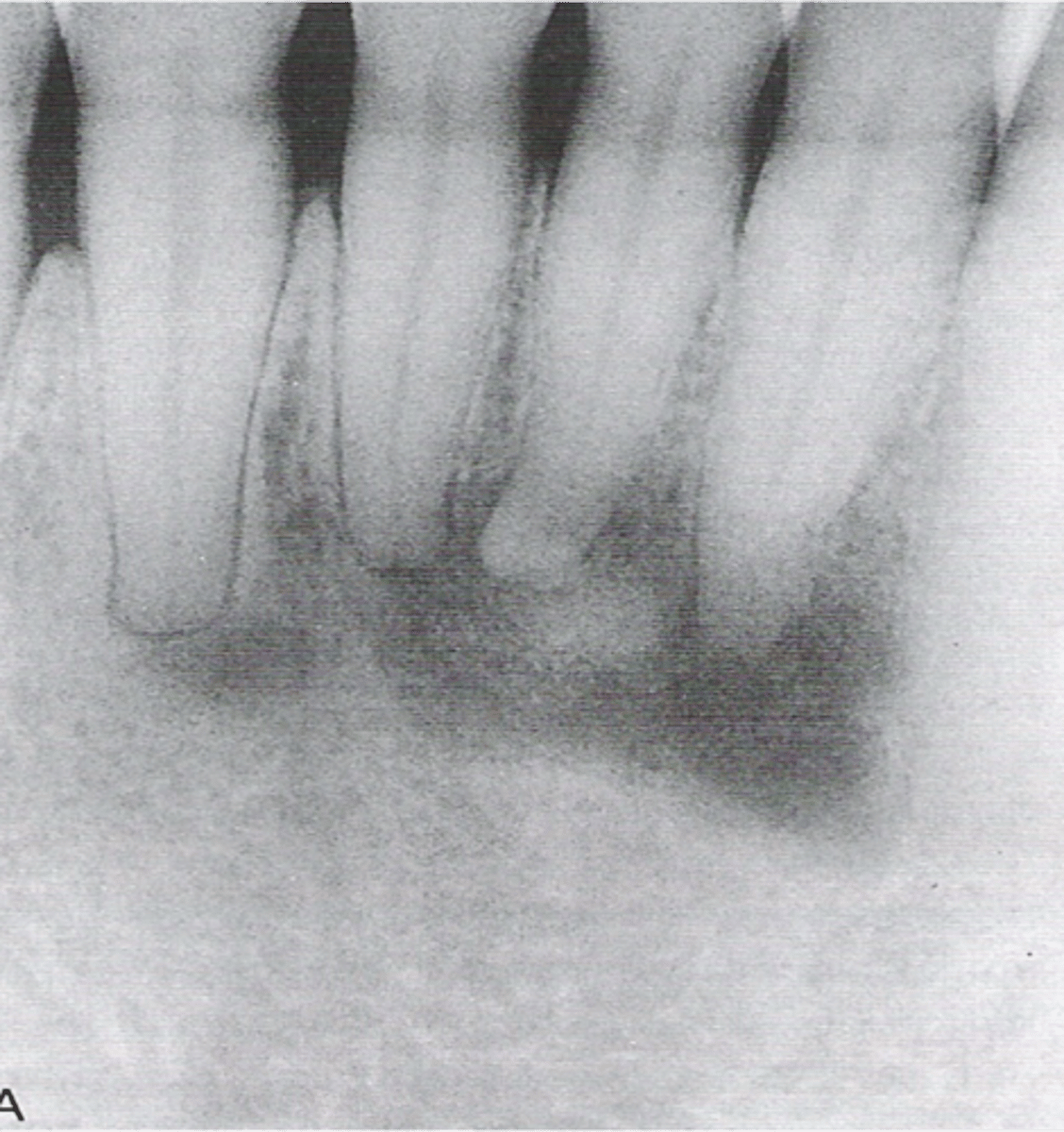 <p>Asymptomatic fibro-osseous lesion</p>