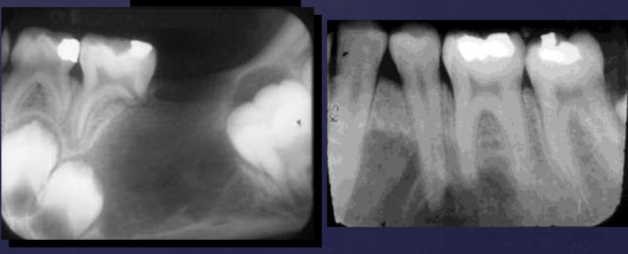 <ul><li><p>expansion + thinning of cortical bone, erosion (aggressive benign lesions)</p></li><li><p>displacement of max sinus floor, IAN canal, teeth w/ external root resorption </p></li></ul><p></p>