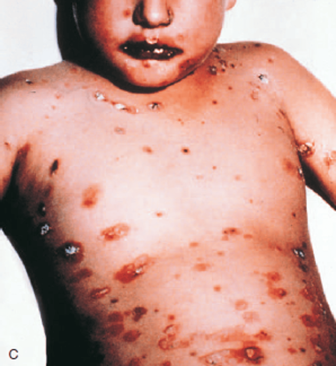 <p>SJS/TEN (Adverse Drug Reaction)</p>