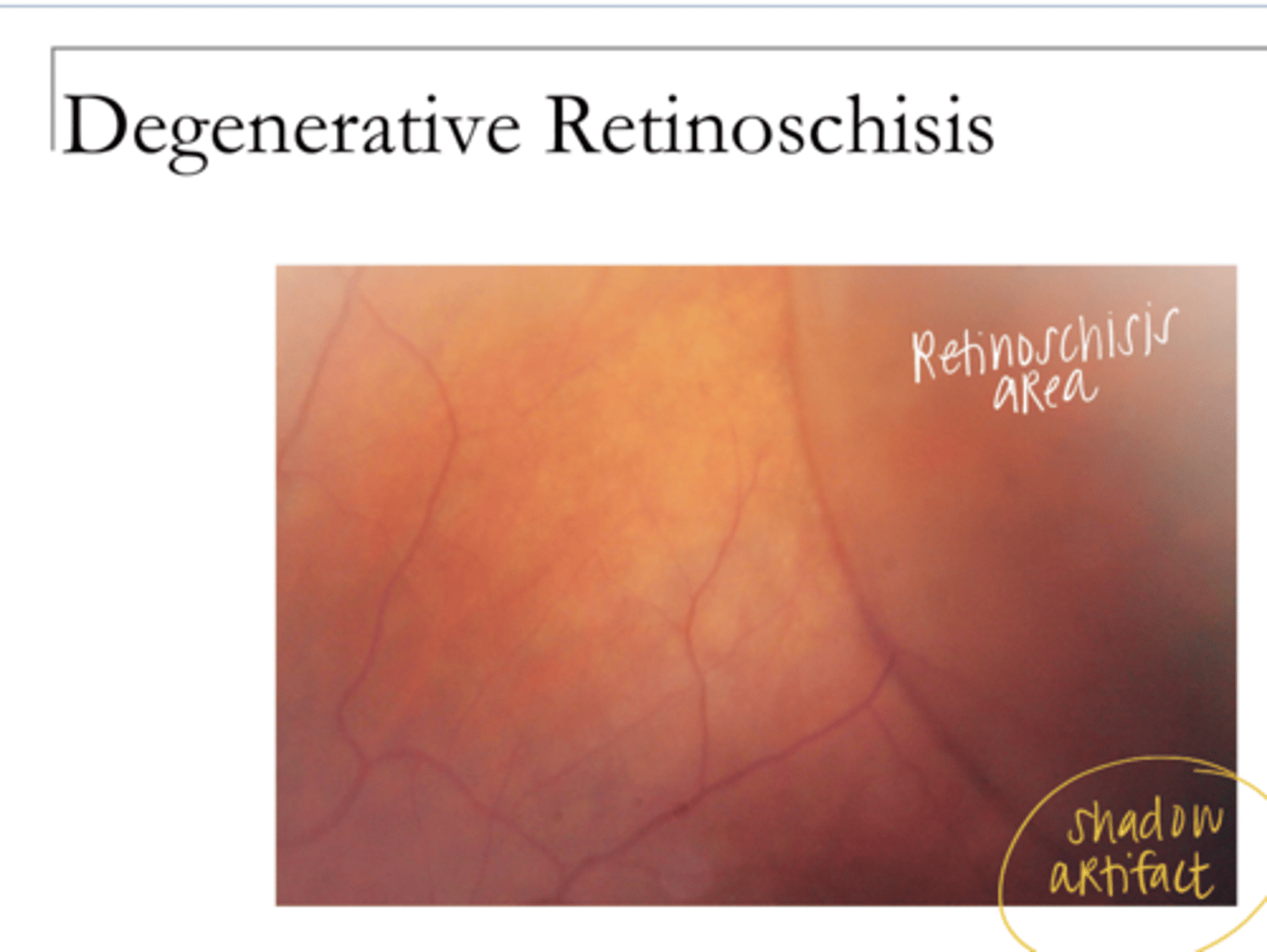 <p>Retinoschisis Pic</p>