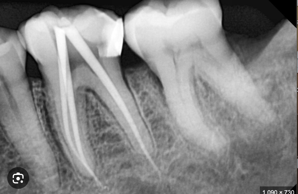 <p>what is periapical xrays</p>