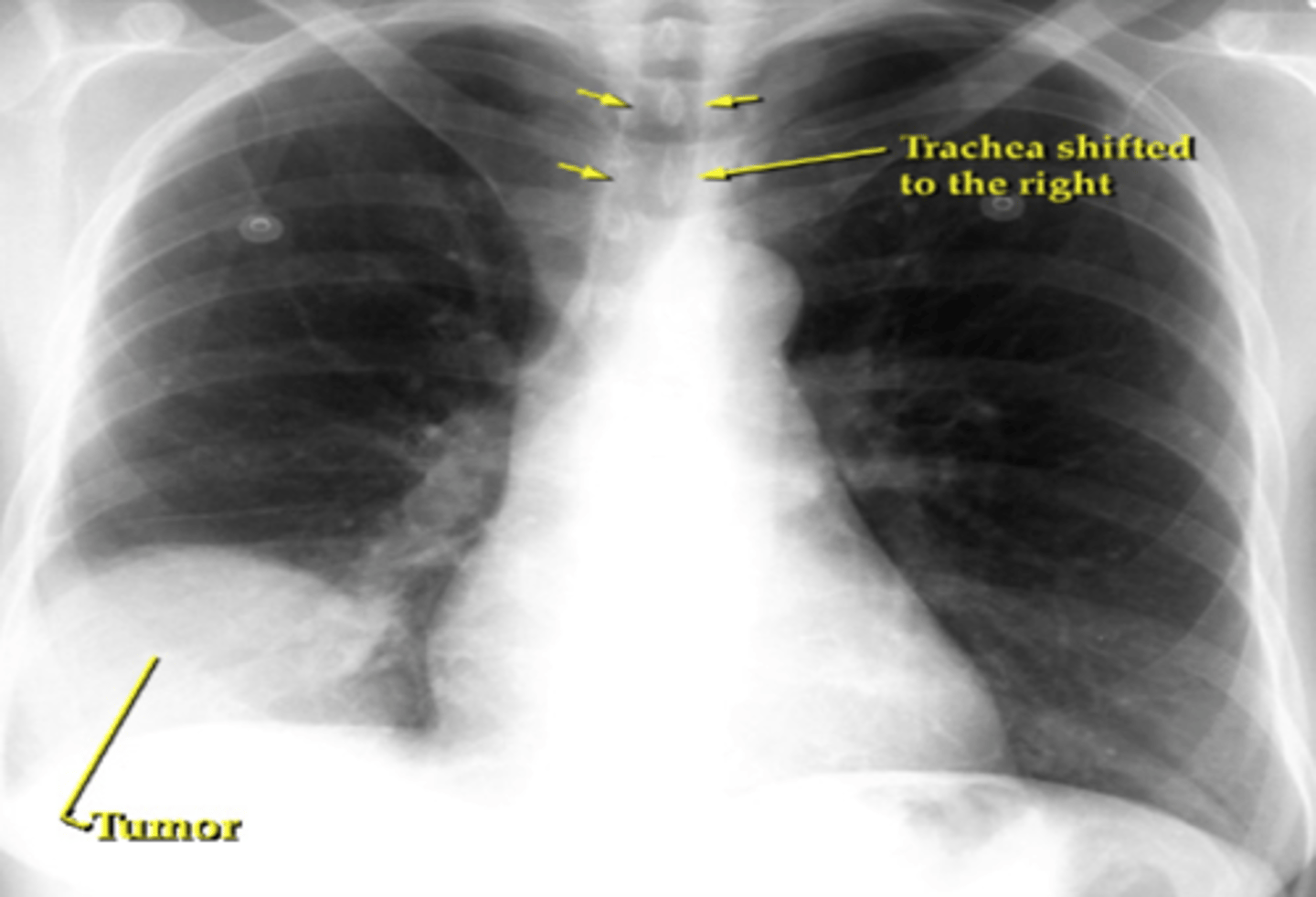 <p><b>adenocarcinoma</b><br>-found in <b>periphery</b> of lungs <br><br>-small cell/scc usually found central</p>