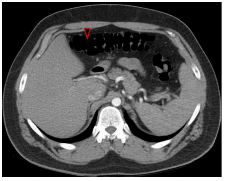 <p>A CT scan from a 55-year-old male with a history of bloody diarrhea reveals the result shown in the accompanying image. What spinal cord levels provide sympathetic innervation to the organ indicated by the red arrowhead?</p><p>A. T12</p><p>B. L1-2</p><p>C. T1-4</p><p>D. S2-4</p><p>E. T5-9</p><p>F. T10-11</p>