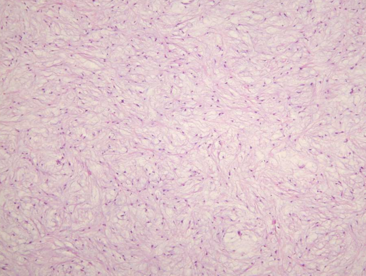 <p>• Loose stroma with collagen fibrils</p><p>• Haphazardly arranged stellate, spindle-shaped, and round cells</p><p>• Inactive rests of odontogenic epithelium may be present</p><p>• May be misdiagnosed as hyperplastic dental follicle</p>