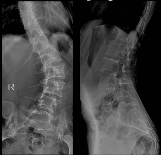 <p>what is seen here for this case of Marfan syndrome?</p>