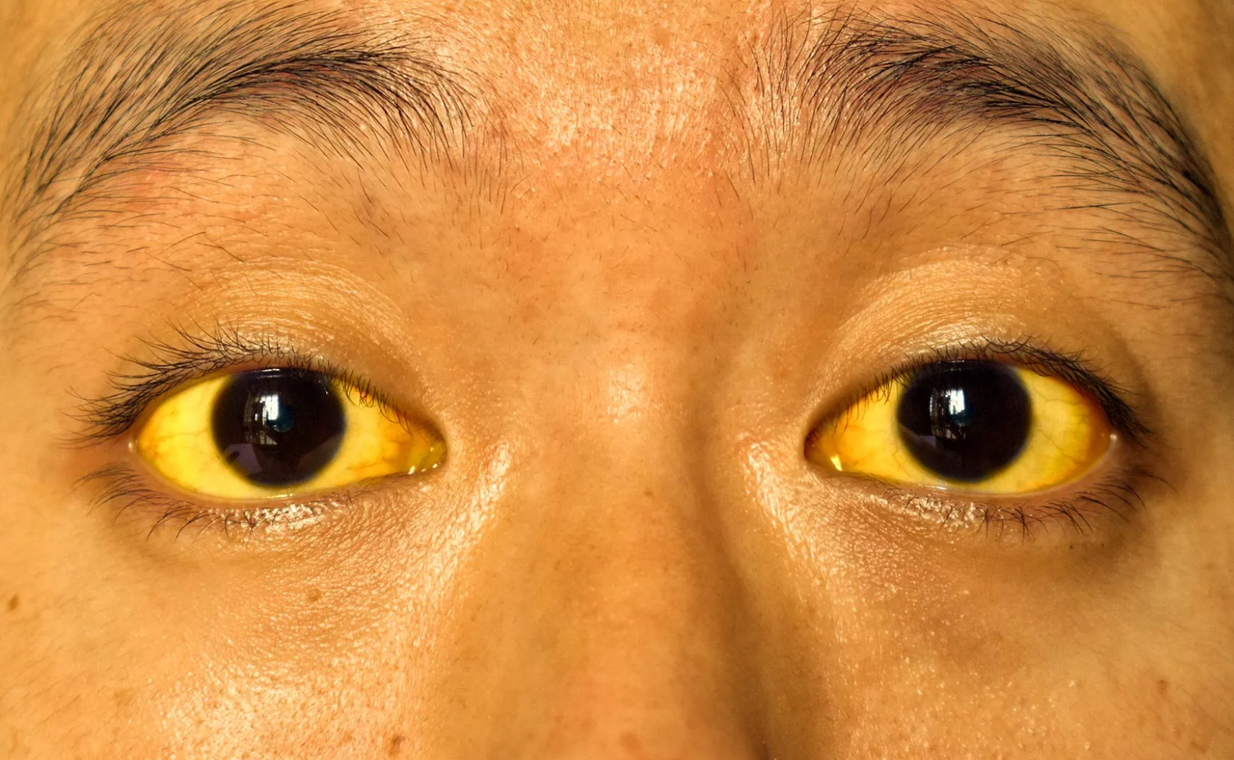 <p>Jaundice</p>