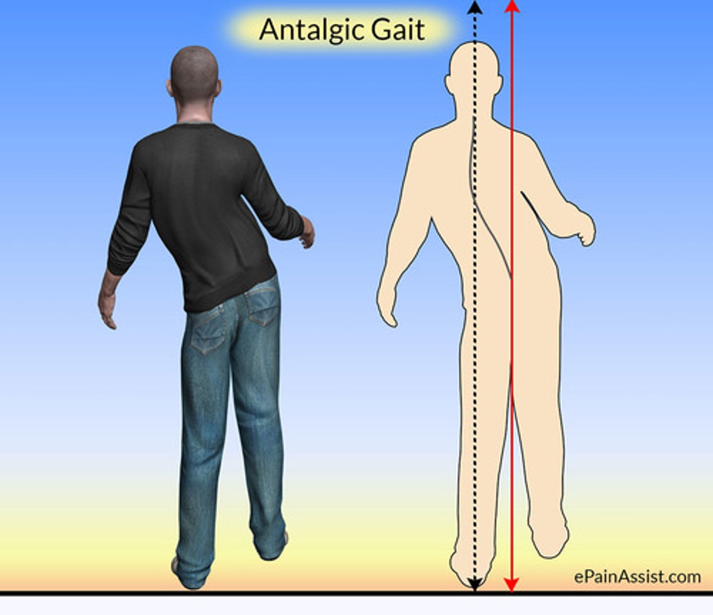 <p>gait pattern that develops as a way to avoid pain while walking (good leg moves faster)</p><p>- "limping'</p>