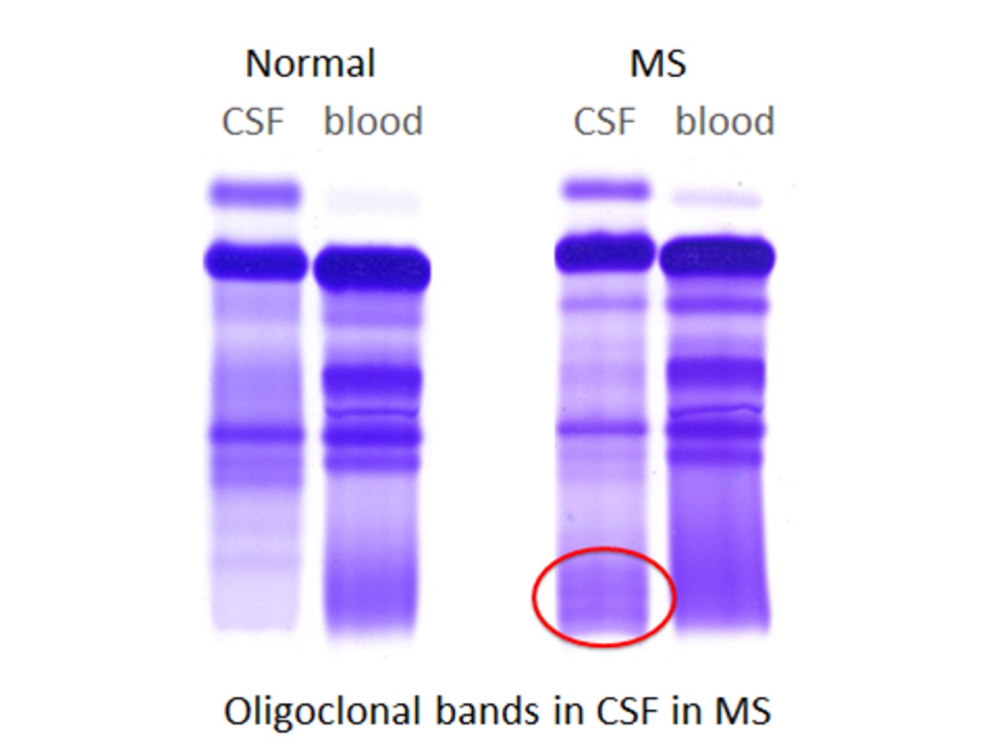 <p>oligoclonal bands</p>