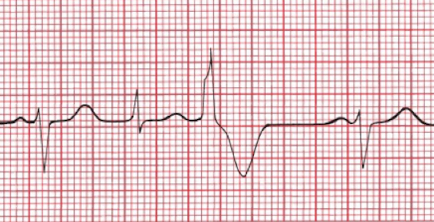 <p>Seen in ventricular tachycardia</p><p>-atrial depolarization slips through AV node, results in QRS morphology that looks part supraventricular/ ventricular</p>