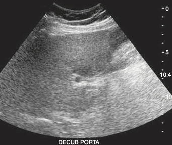 <ol start="16"><li><p><span><strong>An asymptomatic obese adult patient presents<br>with elevated aspartate aminotransferase (AST) and alanine aminotransferase (ALT) levels discovered during a life insurance physical. The hypoechoic area documented in the sonogram most likely represents<br></strong></span></p></li></ol><p></p>