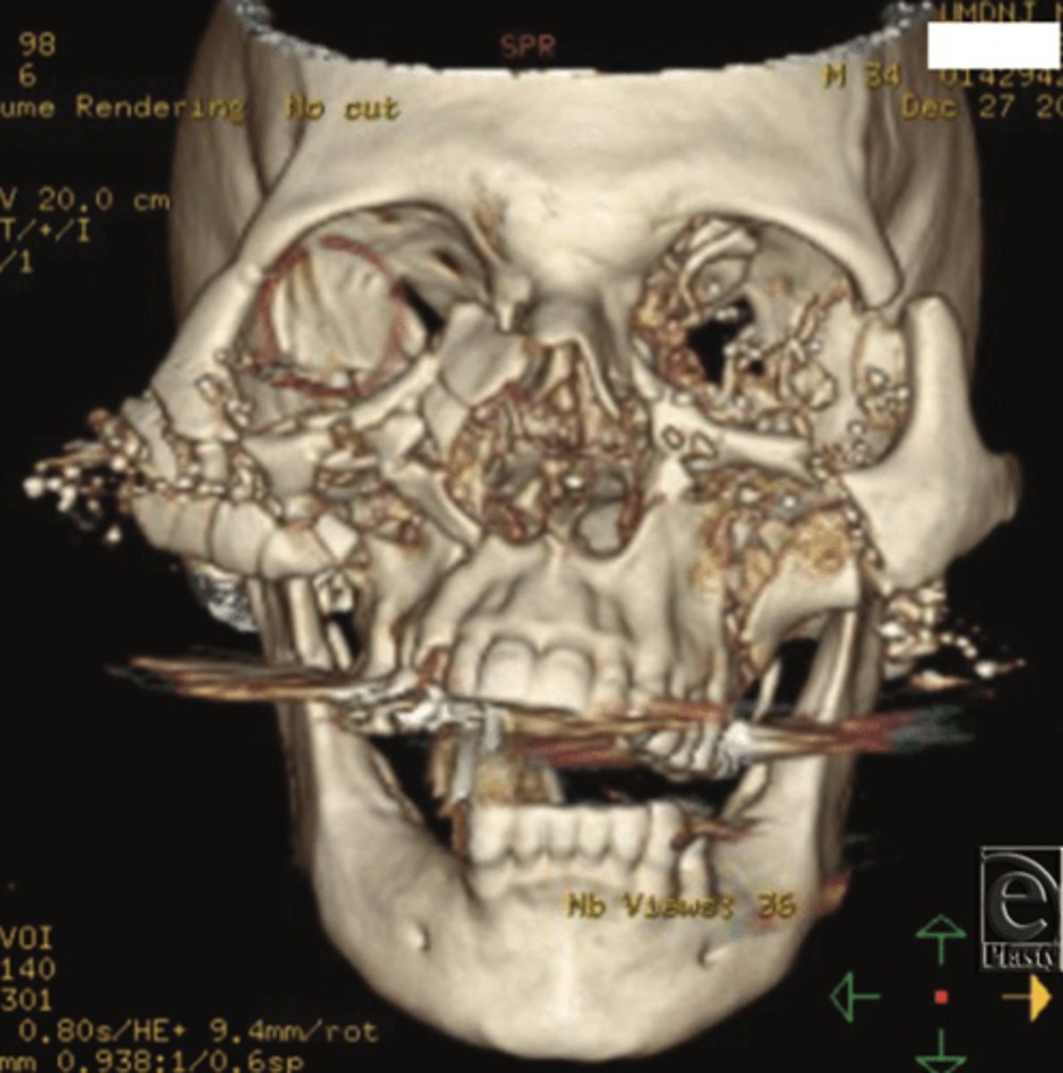 <p>Injuries to the head, face, and teeth are common</p><p>• Approximately one-third are _______ related</p>