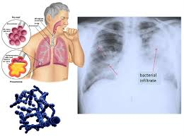 <p>serves as an important cause of mortality in older adults due to <strong>aspiration</strong>…smokers have a higher risk of developing this type of pneumonia</p>