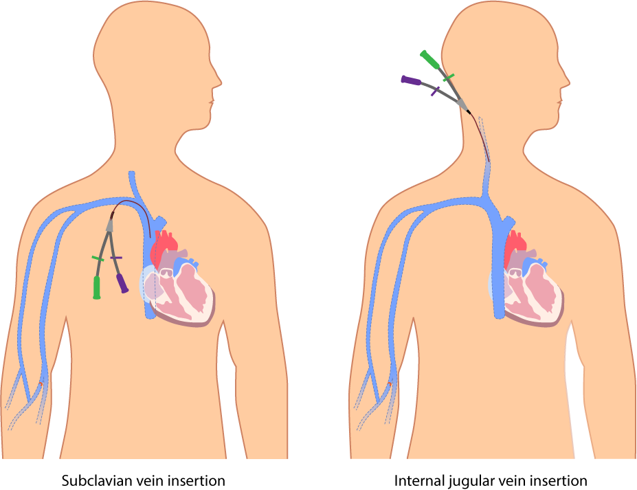 <p>What is the purpose of NTCs (Non Tunneled Catheter)?</p>