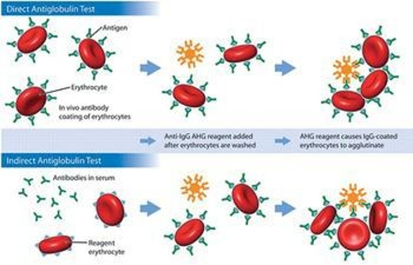 <p>Polyspecific antihuman globulin is added to patient RBCs to detect sensitization.</p>