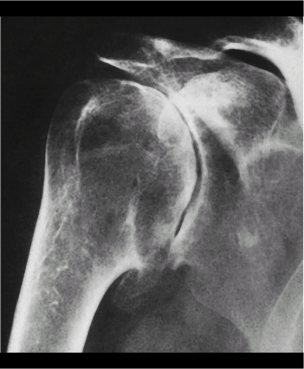 <p>Osteoarthrosis of the shoulder is _____</p><p>- AC joint (MC)</p><p>- Glenohumeral joint</p><p>• Rare</p>