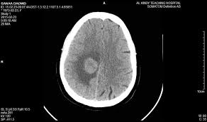 <p>See hemphorages( internal bleeding)</p><p>See tumor</p><p>See fractures and such</p><p>Damage to the meniges(increase contrast on picture)</p>