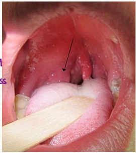 <p><strong>Etiology and Symptoms of Peritonsillar Abscess/Cellulitis </strong></p><p>-Any microorganism that causes _________, most commonly bacteria (group A _____, staph aureus)</p><p>-________ sore throat, _____ deviation of soft palate which pushes the arches and makes it asymmetric</p><p>-Deviation of ______, ________ voice, fever, odynophagia</p><p>-_________, which is the inability to open their mouth due to irritation of pterygoid muscles </p>