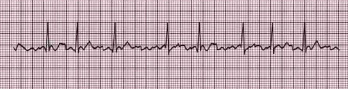 <p>EKG</p>