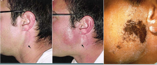 <p>What is the cause of frey syndrome?</p>