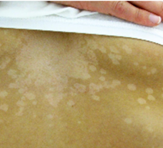 <p>A 14-year-old girl presents to the pediatrician with a 1-week of history of pale spots on her skin. She says that she first noticed the spots after returning from summer field hockey camp and is concerned because they do not seem to be the same shade as the rest of her skin. She enjoys sunbathing at the beach and swimming in the local lake. She denies any symptoms such as fever, pain, itching, redness, or swelling. Physical exam reveals the finding shown in the attached image. Which of the following is the most appropriate test for diagnosing this patient’s disease?</p><p></p><ol><li><p>Culture of skin scraping on Sabouraud dextrose</p></li><li><p>Immunohistochemical staining of punch biopsy</p></li><li><p>Polymerase chain reaction of punch biopsy</p></li><li><p>Potassium hydroxide prep of skin scraping</p></li><li><p>Serology of blood for fungus-specific IgG</p></li></ol><p></p>