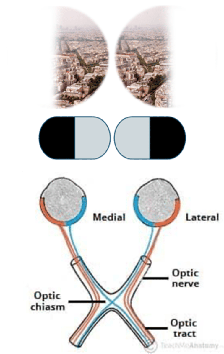 <p>How do expanding pituitary lesions cause Bilateral Hemianopsia?</p>