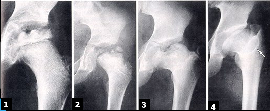 <ol><li><p>Early/Avascular</p><ul><li><p>loss of blood supply to the FH leading to decrease in size</p></li><li><p>increased joint space, lateral femoral displacement</p></li></ul></li><li><p>Fragmentation (of epiphyses)</p><ul><li><p>crescent sign</p></li><li><p>blurred FH outlines</p></li></ul></li><li><p>Repair</p><ul><li><p>return of blood supply</p></li><li><p>new bone deposits</p></li><li><p>wide short femoral neck</p></li></ul></li><li><p>Healed/Deformity </p><ul><li><p>enlarged and flattened FH</p></li><li><p>enlarged GT</p></li></ul></li></ol><p></p>