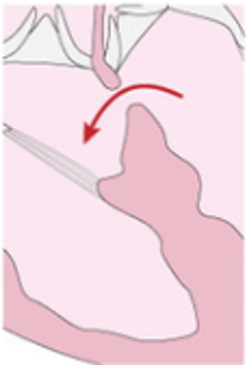 <p>a hole is found at the upper section of the ventricular septum and is very close to the tricuspid and aortic valves.</p>