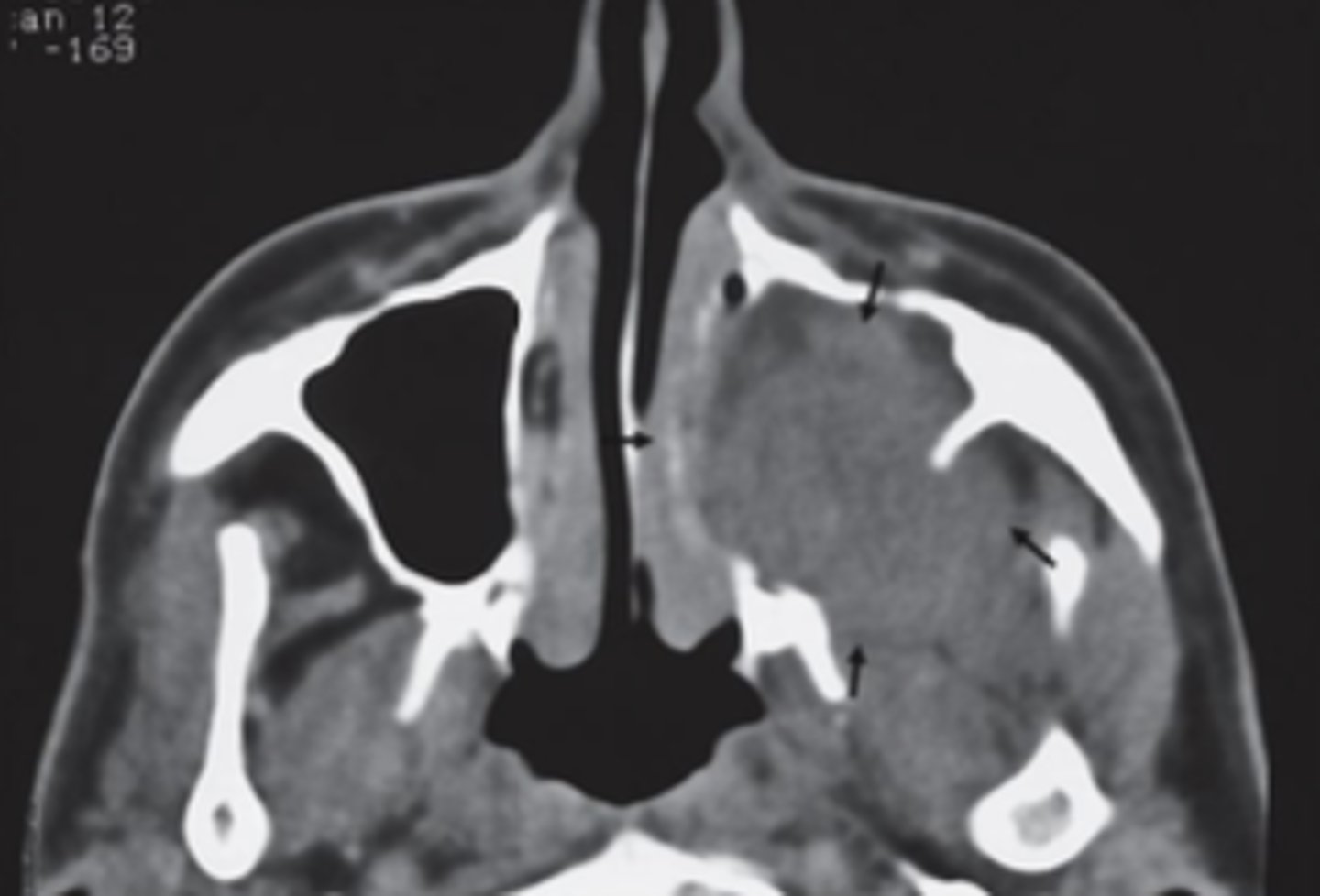 <p>bony margins</p>