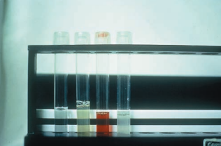 Figure 2: Tubes of CSF with normal, xanthochromic, hemolyzed and cloudy appearances from left to right