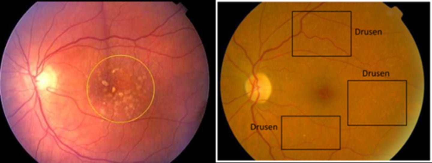 <p>drusen = subRPE = between RPE and Bruch's</p><p>pseudodrusen = subretinal = between retina and RPE</p>