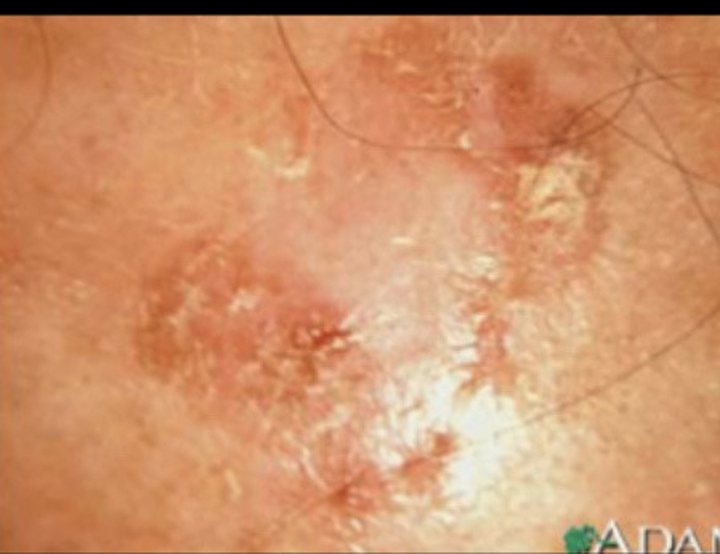 <p>Actinic Keratosis (AK)</p>