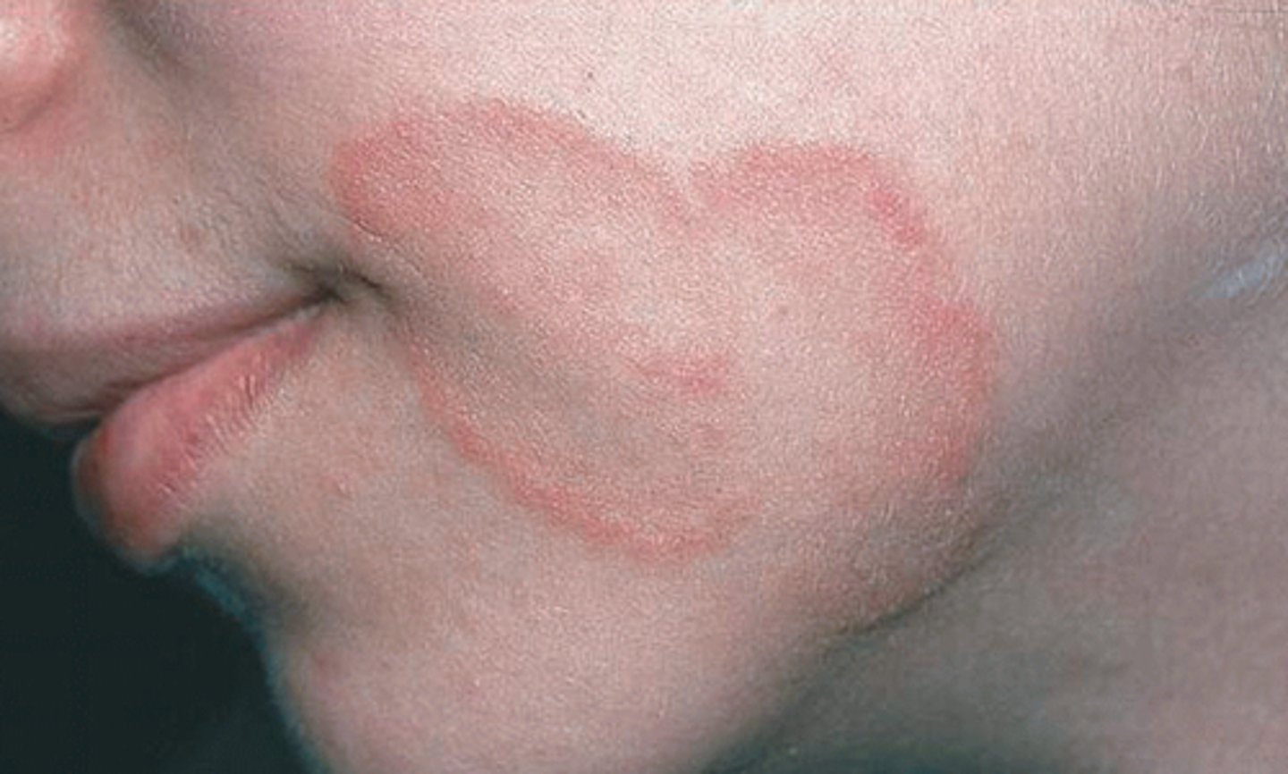 <p>circular shaped lesions<br><br>Example: annular lesion of tinea faciale (ringworm)</p>