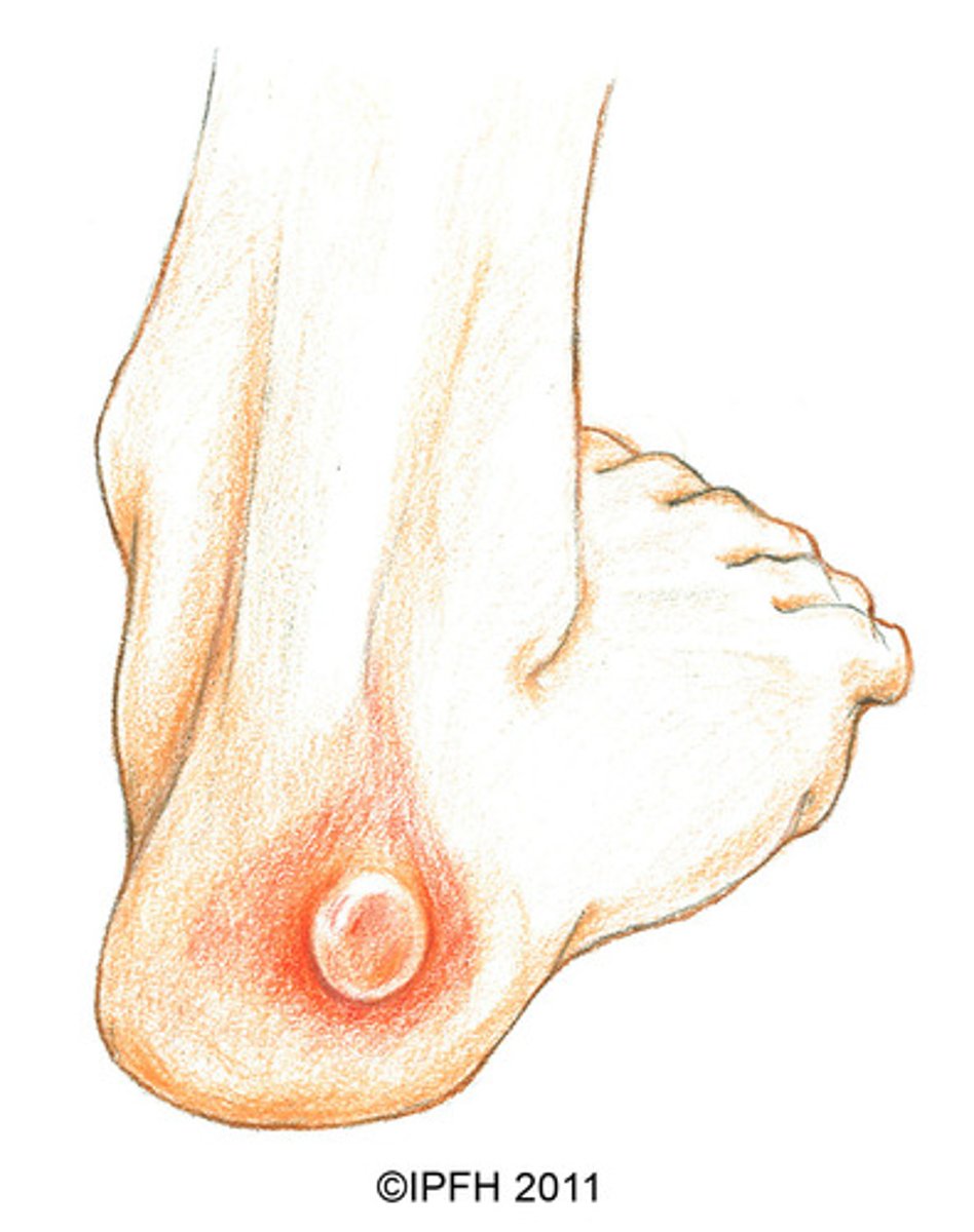 <p>vết phồng/bỏng rộp, chỗ da bị rộp</p>