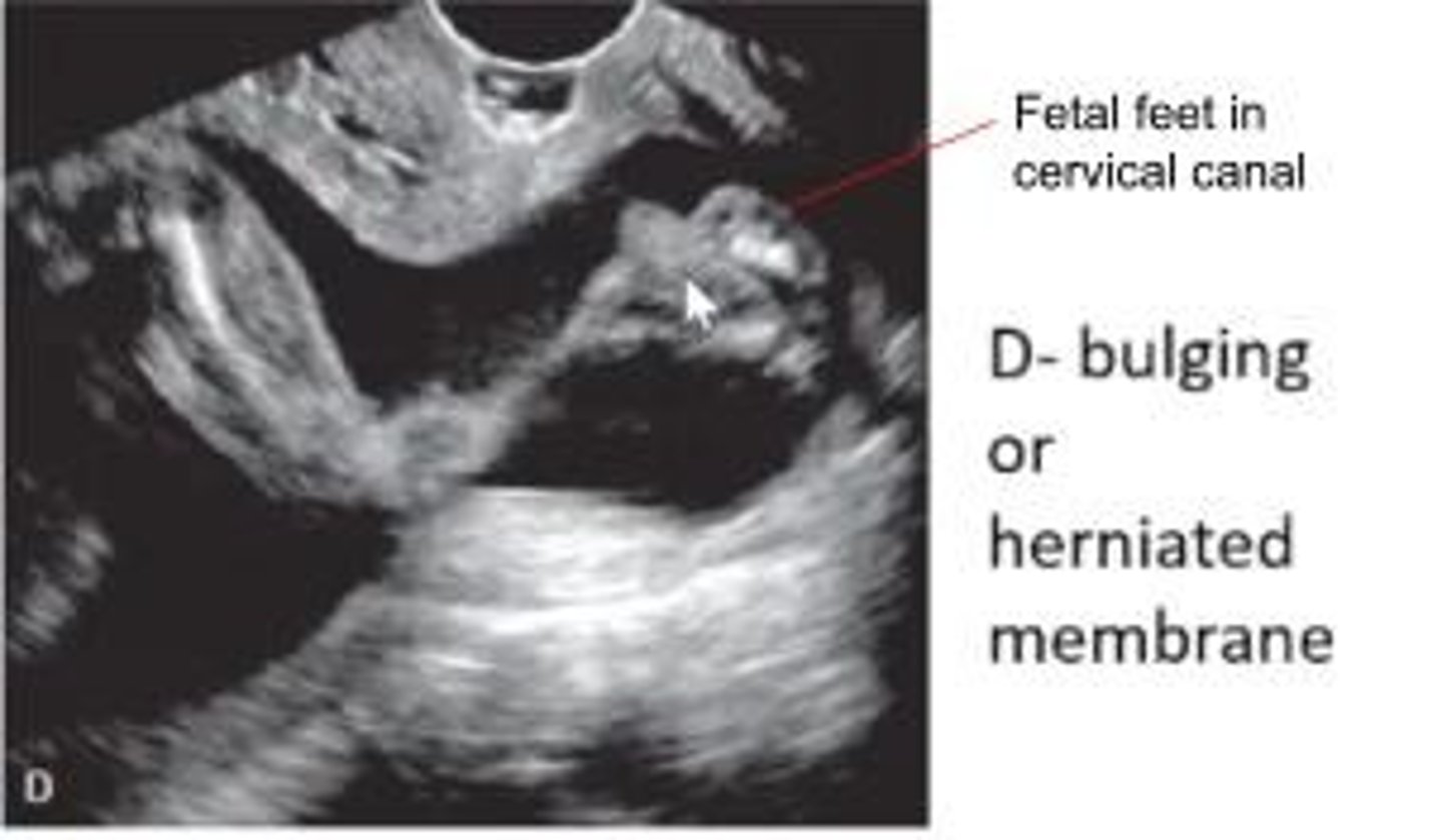 <p>- Dilation and herniation of membranes into cervical canal</p><p>- Width of the funnel - more than 8mm (TAS) or 5mm (TVS) = abn</p><p>- Length from top to bottom of funnel = more than 3-6 mm = abn</p>