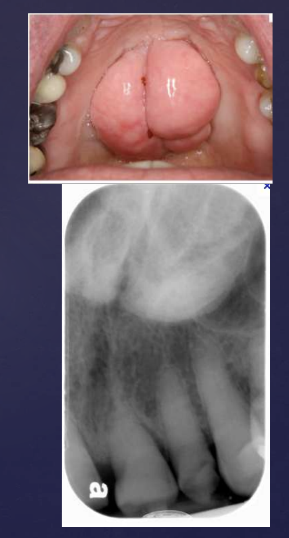 <p>• Dense radiopaque shadow attached to the hard palate </p><p>• Well defined periphery, may have convex or lobulated outline </p><p>• Maybe superimposed over roots of teeth</p>
