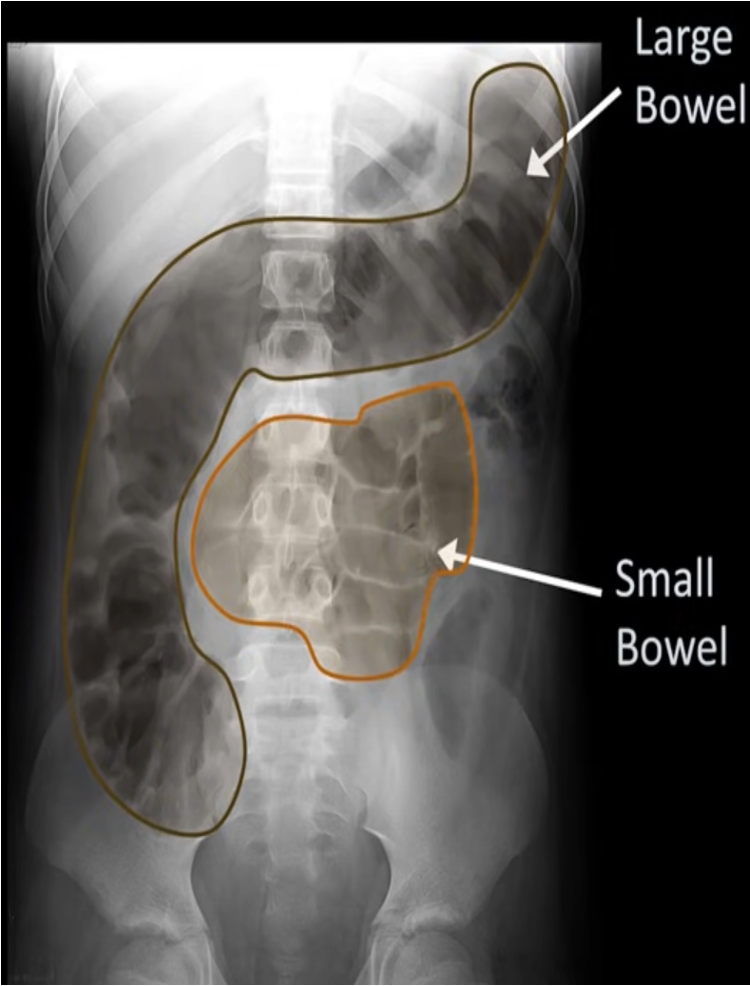 <p><strong>Toxic megacolon</strong></p>