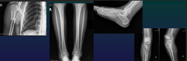<p>APPEARANCE</p><ul><li><p>Fissure (subtle)</p></li><li><p>Complete (total disruption)</p></li><li><p>Incomplete (ONLY one cortical disrupted)</p></li></ul><p> </p><p>COURSE (single or multiple)</p><ul><li><p>Transverse (diaphysis)</p></li><li><p>Oblique (bending)</p></li><li><p>Helical (torsion)</p></li><li><p>Cominuted</p></li><li><p>Layered</p></li></ul><p></p>